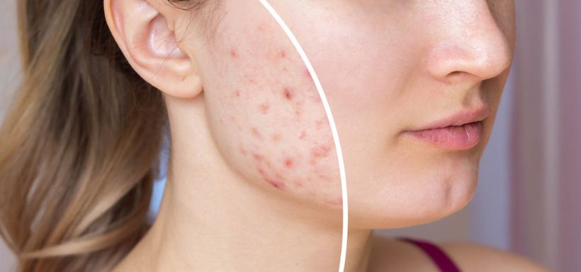 Solutions et traitements naturels pour réduire les cicatrices d&#8217;acné.
